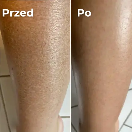 Goleń przed i po – sucha, łuszcząca się skóra, potem gładka