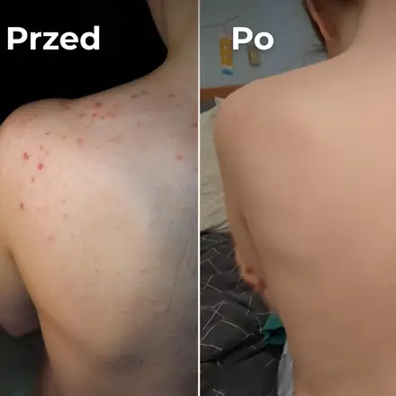 Plecy przed i po – gładsza skóra