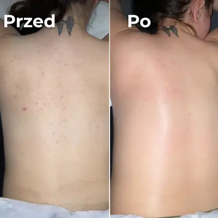 Plecy przed i po – drugi przykład
