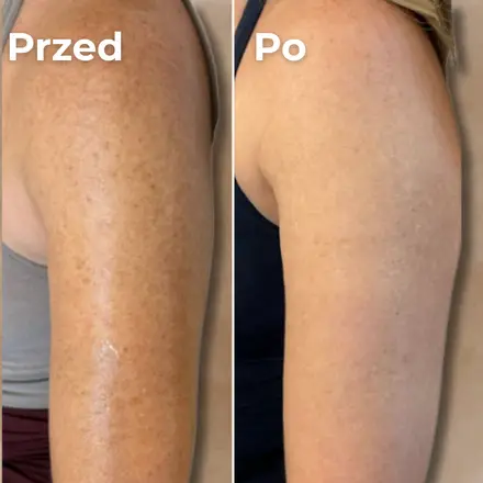Ramię przed i po – chropowate, potem gładkie